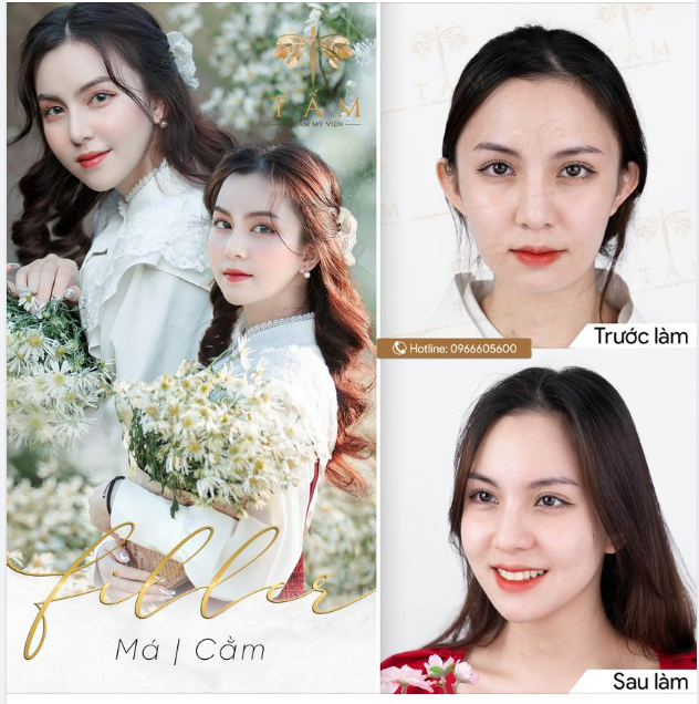 Xóa bỏ khuyết điểm, Xóa bỏ tự ti với COMBO FILLER MÁ, CẰM