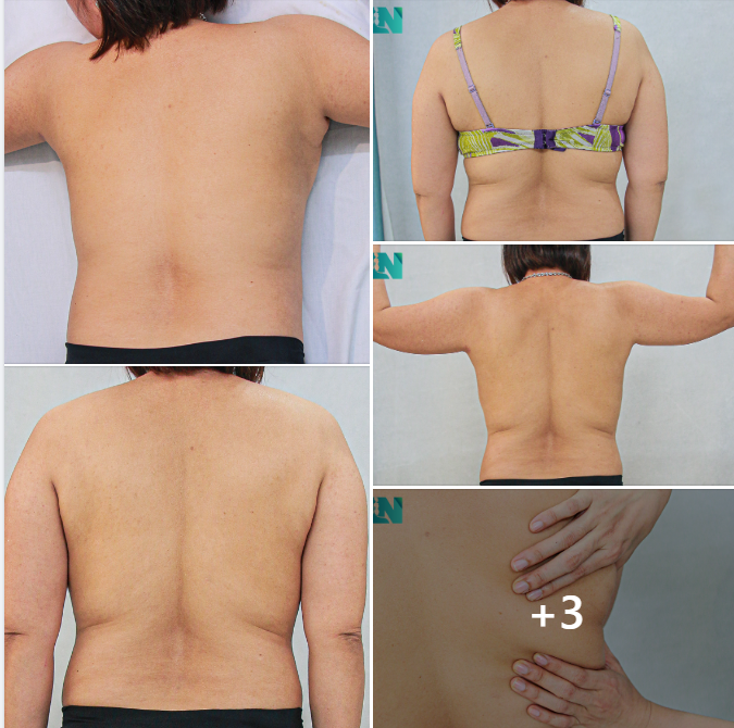 HÚT MỠ TẠO DÁNG THẨM MỸ VÙNG LƯNG, CÁNH TAY, NÁCH CHO CHỊ KH THÂN THUỘC – THỰC HIỆN NHIỀU DỊCH VỤ THẨM MỸ TẠI EKIP BÁC SĨ LƯƠNG NGỌC.