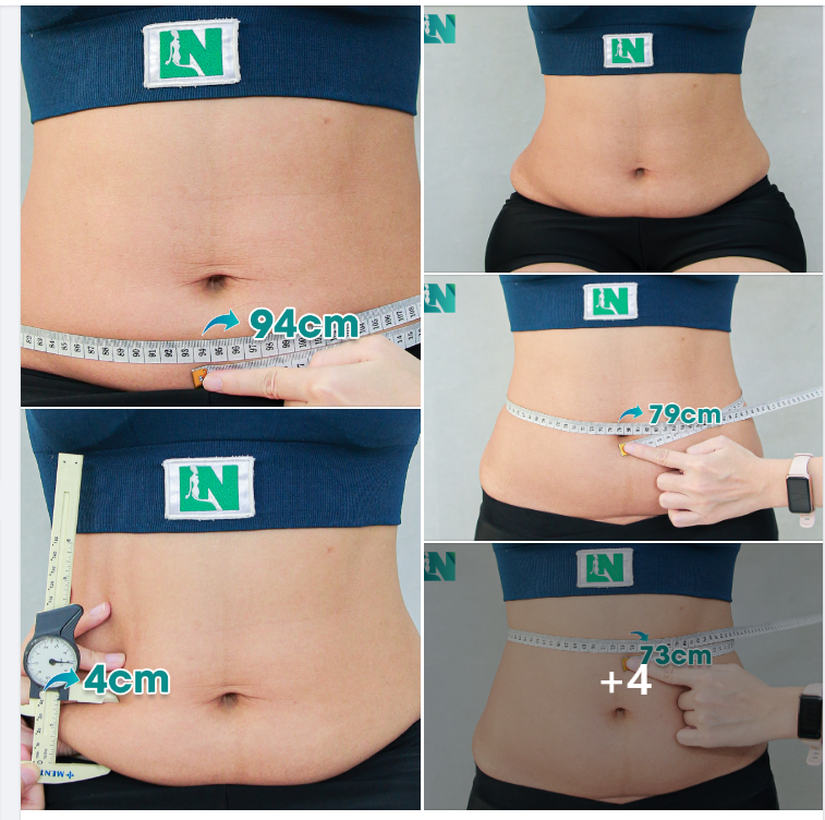 HÚT MỠ TẠO DÁNG THẨM MỸ KẾT HỢP CẤY MỠ NGỰC CHO CHỊ KH 33 TUỔI. MONG MUỐN CẢI THIỆN DÁNG VÓC SAU SINH. TRỰC TIẾP 15H00 – 15H30 HÔM NAY