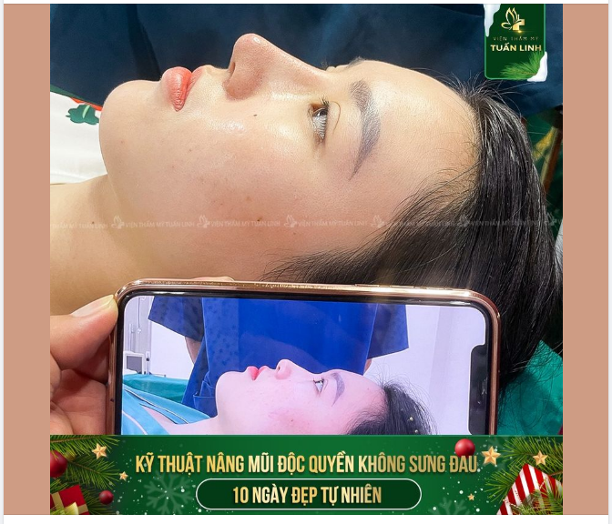 NÂNG MŨI KHÔNG ĐAU - KHÔNG SẸO - ƯU ĐÃI GIẢM NGAY 3TR!!!