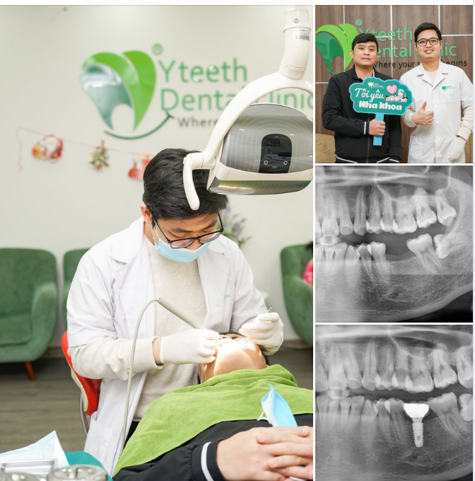 Mất răng hàm làm chức năng ăn nhai bị kém đi và đổ răng