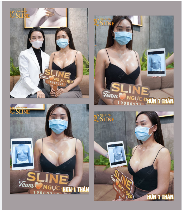 Bạn có muốn JOIN ngay team “ngực đẹp” sau khi nhìn thấy feedback nâng ngực sau 1 tháng này không???