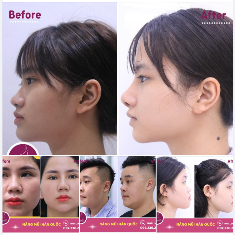 Để tạo ra một sự thay đổi đáng kể trên khuôn mặt thì Nâng Mũi chính là lựa chọn Ưu tiên cho những ai đang cần cải thiện nhan sắc