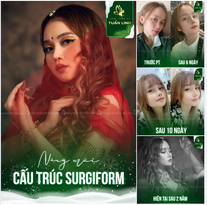 Nâng muic cấu trúc  Surgiform phương pháp nâng mũi số 1 được các chuyên gia khuyên bạn lựa chọn 
