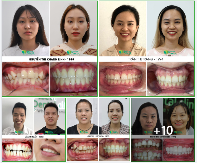 Cùng ngắm nhìn sự thay đổi của case Niềng Răng tại Yteeth