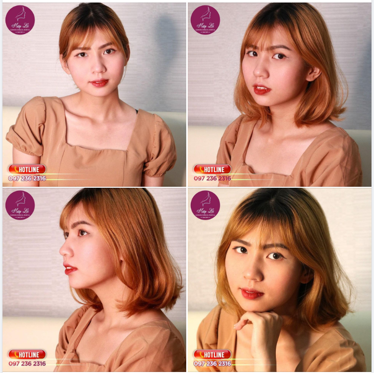 Cùng ngắm nhìn khuôn mặt đầy thần thái hút hồn và tự tin tạo dáng của cô gái nhỏ Sài Gòn sau 3 tuần Nâng mũi tại Hiệp Lợi