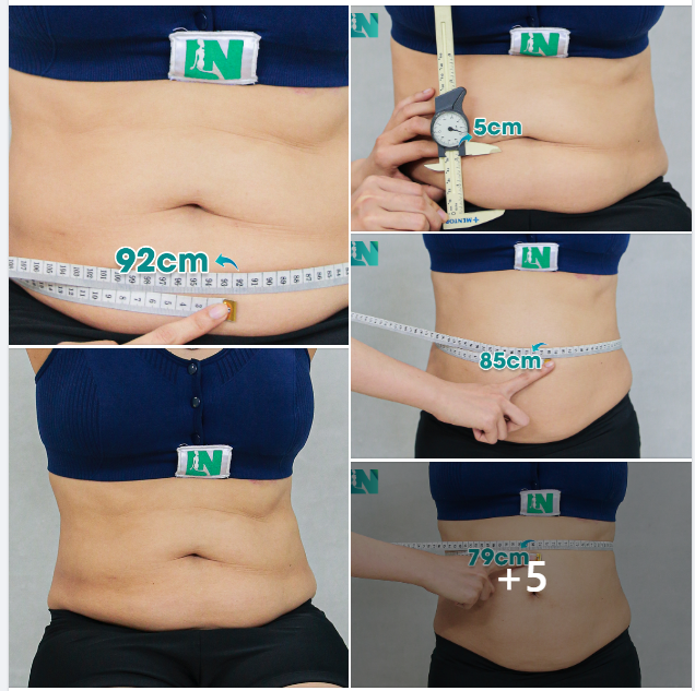 HÚT MỠ TẠO DÁNG THẨM MỸ CHO CHỊ KH 7X TỪNG THỰC HIỆN DỊCH VỤ THẨM MỸ TẠI EKIP BÁC SĨ LƯƠNG NGỌC. TRỰC TIẾP 11H30 – 12H00 HÔM NAY