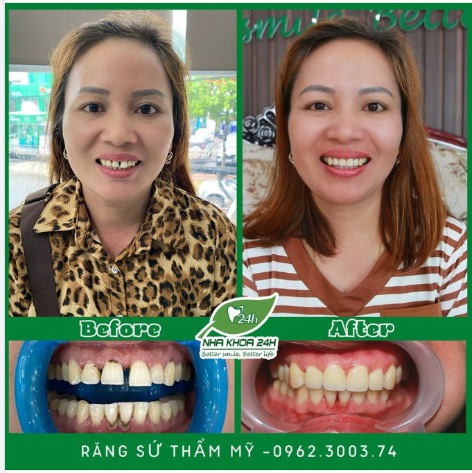 SỰ THAY ĐỔI KỲ DIỆU VỚI DỊCH VỤ RĂNG SỨ THẨM MỸ