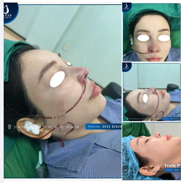 MŨI SỬA LẠI TẠI LATIN ĐẸP NHƯ THẾ NÀO?
