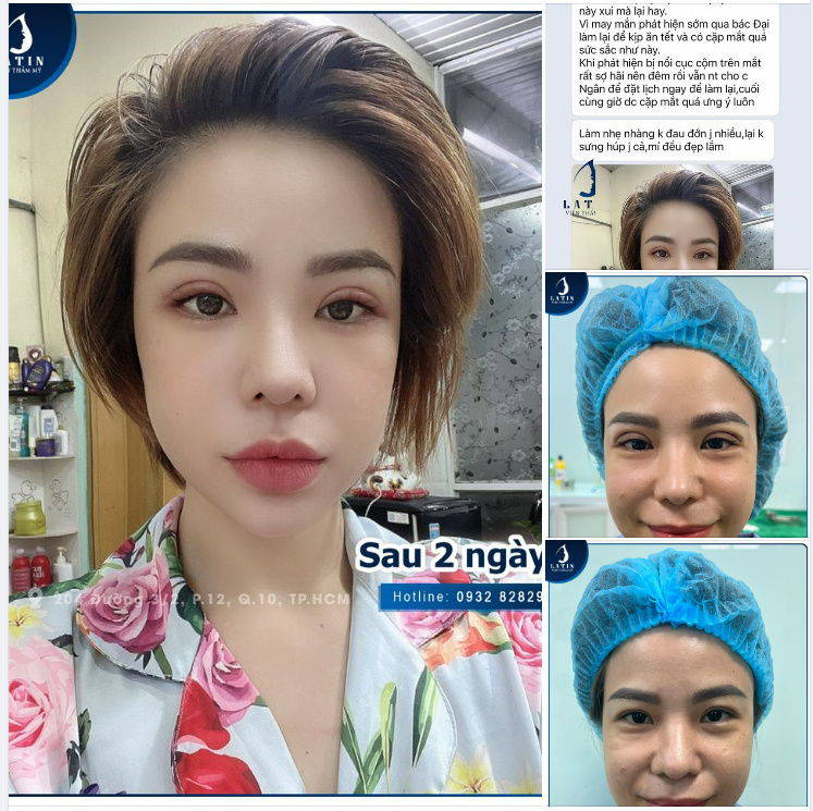 Có một feedback cắt mí xinh đẹp như thế!