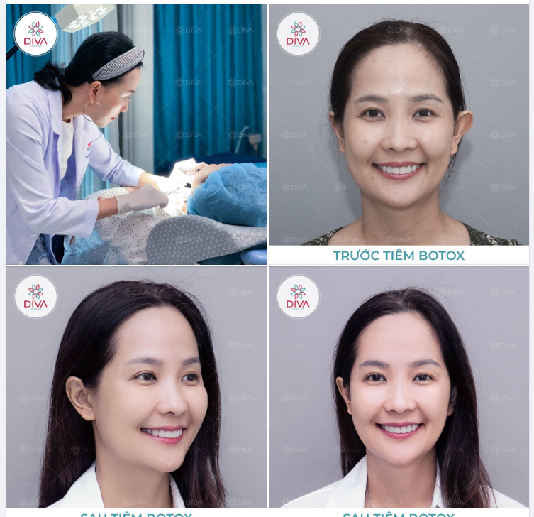 TIÊM BOTOX - PHƯƠNG PHÁP XÓA NHĂN HIỆU QUẢ