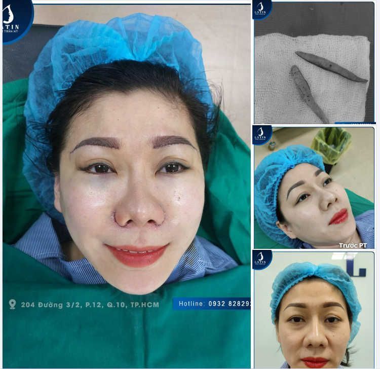 ĐỪNG ĐỂ NHỮNG NẾP NHĂN LÀM GIÀ HÓA KHUÔN MẶT BẠN?