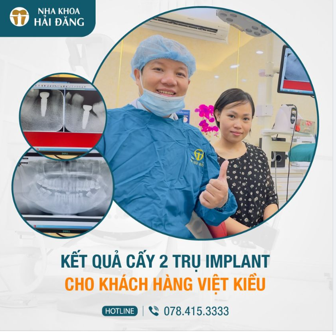 KẾT QUẢ CẤY 2 IMPLANT STRAUMANN CHO K/H VIỆT KIỀU