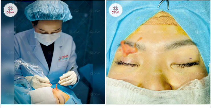 TẠM BIỆT MỠ THỪA MÍ MẮT CHỈ SAU 10 PHÚT!