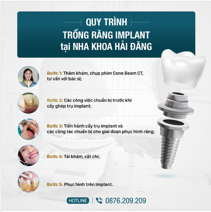 MỘT CA TRỒNG RĂNG IMPLANT SẼ DIỄN RA NHƯ THẾ NÀO?
