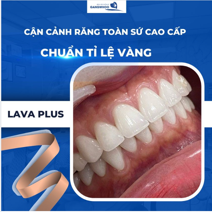 CẬN CẢNH RĂNG TOÀN SỨ CHUẨN TỶ LỆ VÀNG - LAVA PLUS