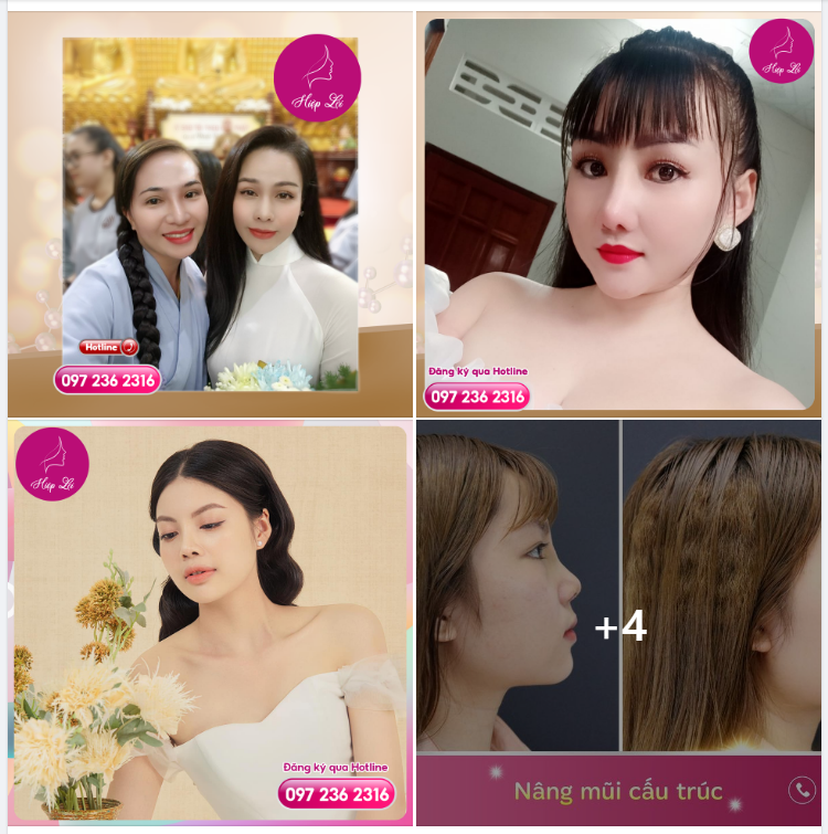 NÂNG MŨI CẤU TRÚC - SUNG TÚC QUANH NĂM