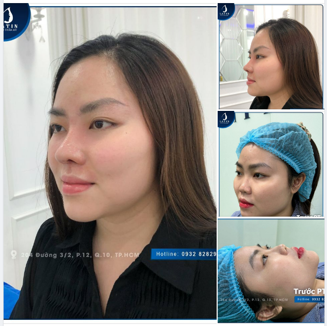 Vừa kịp mũi đẹp đón Giáng sinh Khách hàng nhà Latin tái khám và cắt chỉ sau 10 ngày nâng mũi cấu trúc