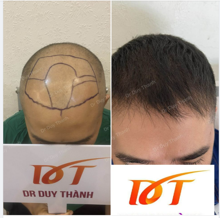 SHOCK 3 THÁNG 22 NGÀY SAU CẤY 2000 NANG TÓC.