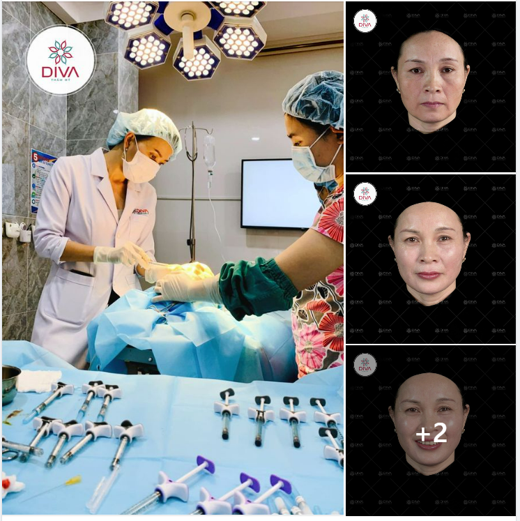 TIÊM FILLER NHIỀU, MẶT CÓ BỊ PHÌNH TO RA HAY KHÔNG ?