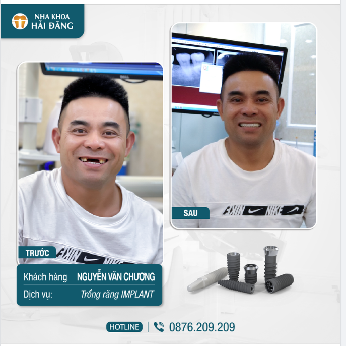Trồng răng Implant thay thế răng mất hoàn hảo