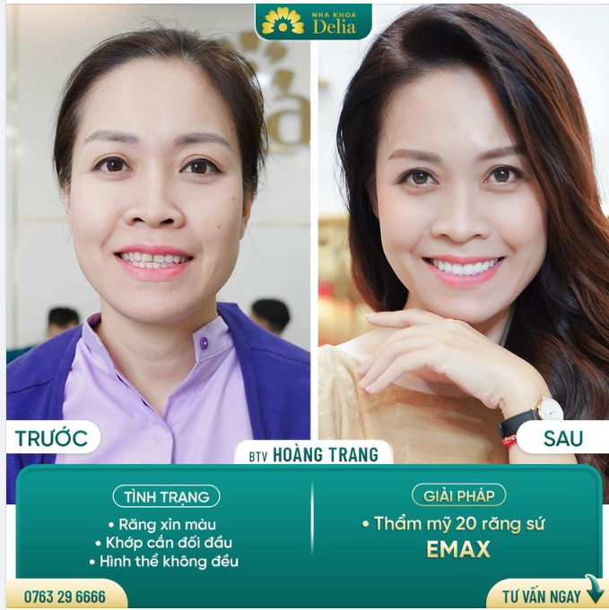 Chỉ sau 48H Khắc phục khớp cắn đối đầu, răng thưa - ố vàng cho BTV Hoàng Trang