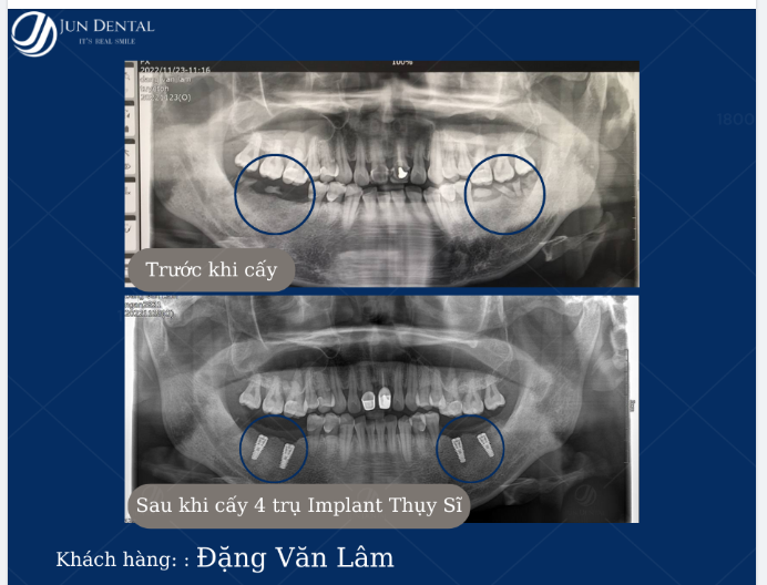 "Anh chẳng còn từ nào để diễn tả vì thực sự anh quá hài lòng, cấy răng xong hiện tại chẳng thấy đau đớn gì!"