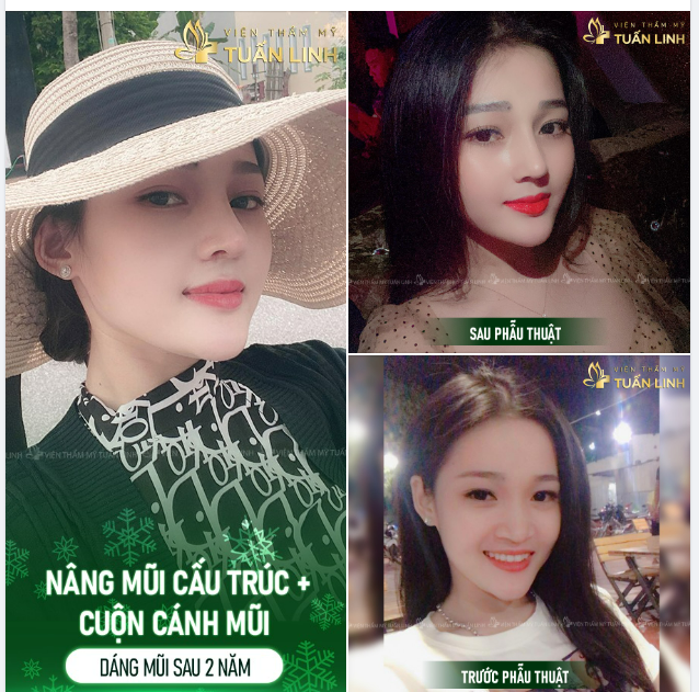 Tút lại nhan sắc đón Noel thôi khách ơi! Chỉ 90 phút có ngay dáng mũi cao bay nhẹ nhàng - Nhan sắc xứng đáng có 100 người yêu.