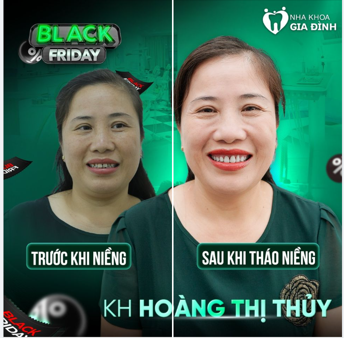 KH U50 QUYẾT TÂM NIỀNG RĂNG VÀ KẾT QUẢ SAU 2 NĂM KIÊN TRÌ