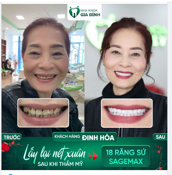 LÃO HOÁ NGƯỢC” SAU KHI THẨM MỸ RĂNG CHỈ SAU 2 NGÀY TẠI NHA KHOA GIA ĐÌNH