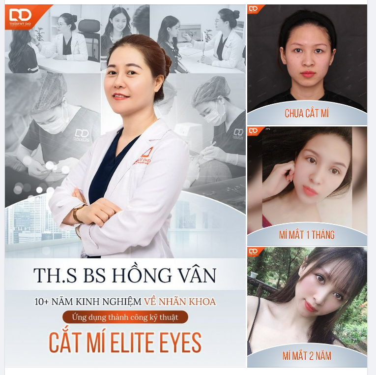 Hình ảnh khách hàng sau 2 năm cắt mí Elite Eyes tại DrD