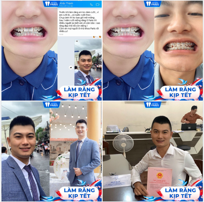 Niềng răng mắc cài kim loại - là xấu???