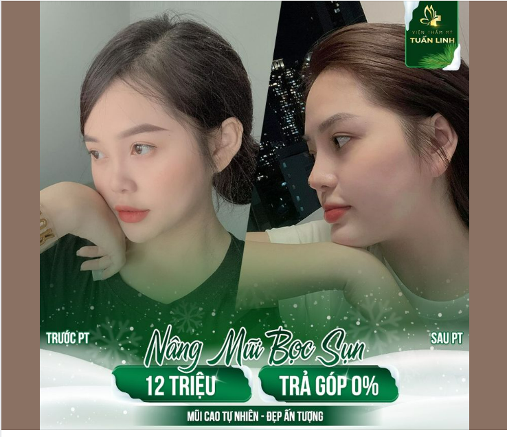 SỞ HỮU DÁNG MŨI NHƯ Ý CHỈ VỚI 12TR NÂNG MŨI BỌC SỤN!!!
