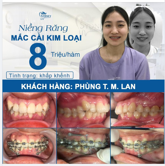 Thay đổi nụ cười khấp khểnh chỉ với 8 triệu/hàm