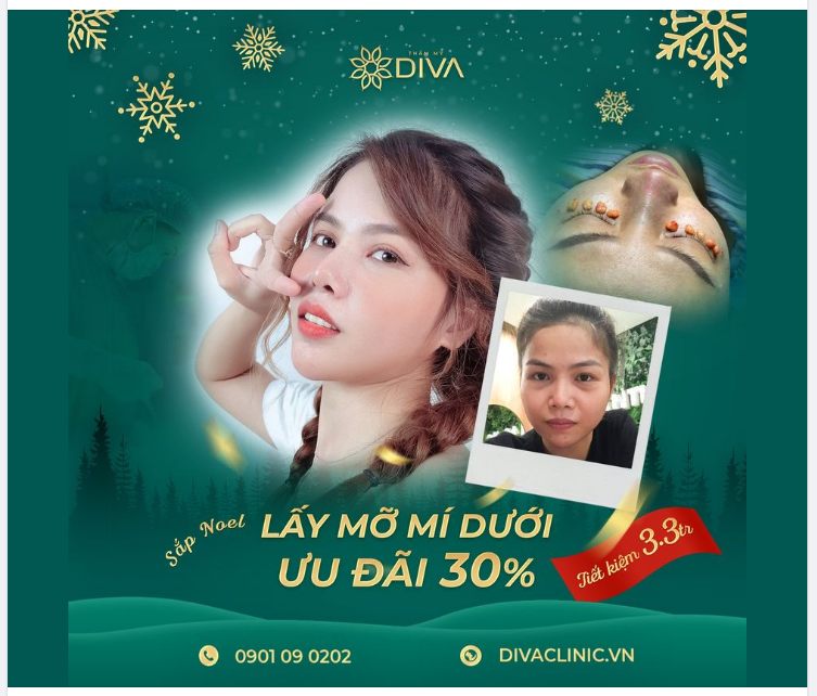 LẤY TÚI MỠ MÍ MẮT DƯỚI: TRẺ HÓA VÙNG MẮT