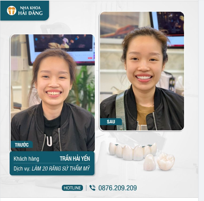 Thẩm mỹ răng sứ cải thiện hoàn toàn tình trạng răng