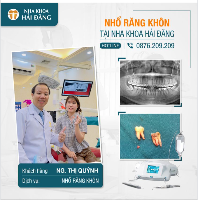 KHÔNG SƯNG, KHÔNG ĐAU SAU KHI NHỔ CÙNG LÚC 2 RĂNG KHÔN