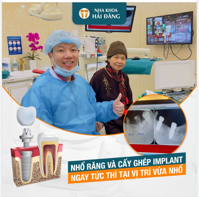 Nhổ răng cấy ghép implant ngay tức thì tại vị trí nhổ