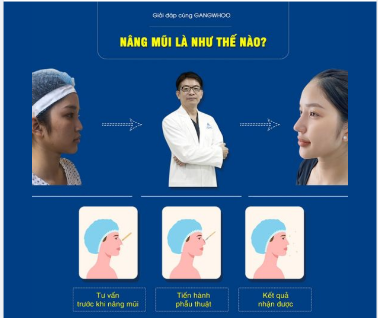 NÂNG MŨI LÀ NHƯ THẾ NÀO?