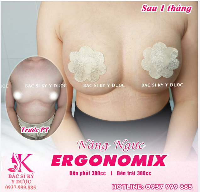 Dáng ngực chuẩn tại Bác sĩ Kỳ Y Dược có 3 đặc điểm chính như sau: