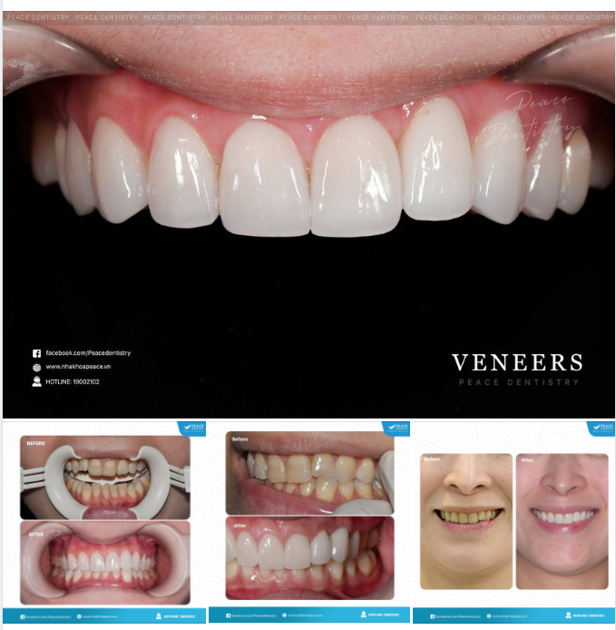 Chỉ với  8 mặt dán sứ Veneer giúp chị khách hàng sở hữu nụ cười ưng ý nhất