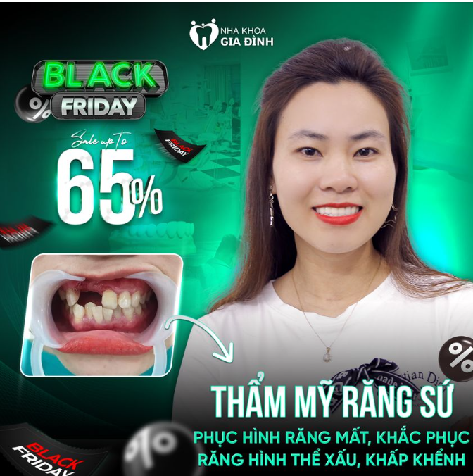 BIẾN RĂNG KHÔNG NHƯ Ý THÀNH ĐỀU ĐẸP CHỈ SAU 2 LẦN HẸN