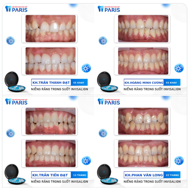 100+ KH chọn niềng răng trong suốt để ĐẸP KỊP TẾT 2023.