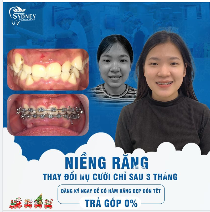 Niềng răng xinh tự tin đón Tết