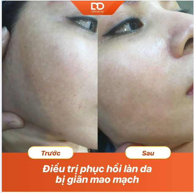 PHỤC HỒI LÀN DA GIÃN MAO MẠCH TỨC THÌ