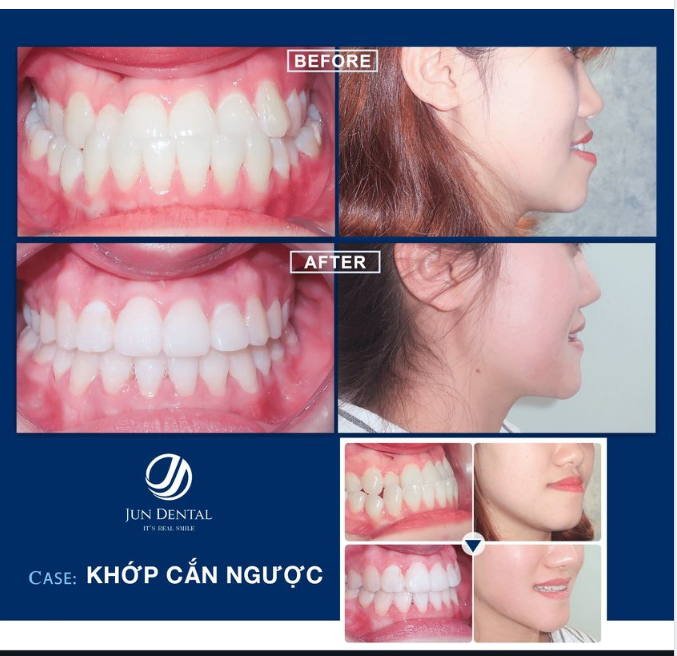  KHỚP CẮN NGƯỢC - HÃY ĐẾN JUN DENTAL