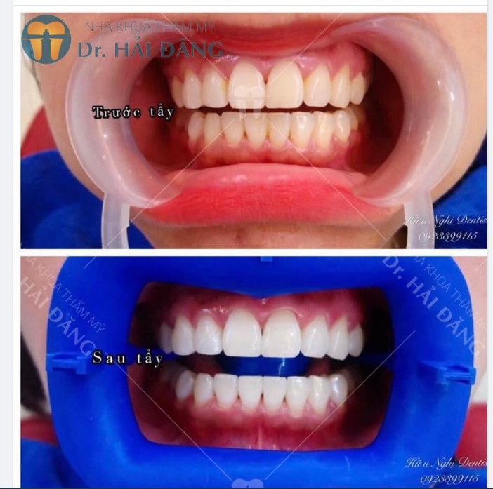 RĂNG TRẮNG SÁNG ĐÓN XUÂN SANG