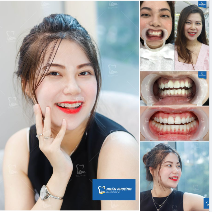 Mắc cài sáng trong - Long lanh răng đẹp