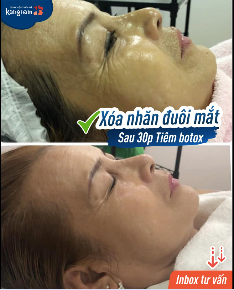 Trợ giá xóa nhăn mắt/ cau mày/ trán chỉ 4,5 Triệu