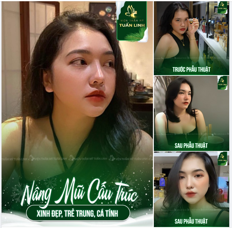 MŨI CAO XINH ĐÓN NĂM MỚI TÀI LỘC